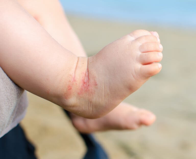 Consejos para el manejo del eczema en tu hijo